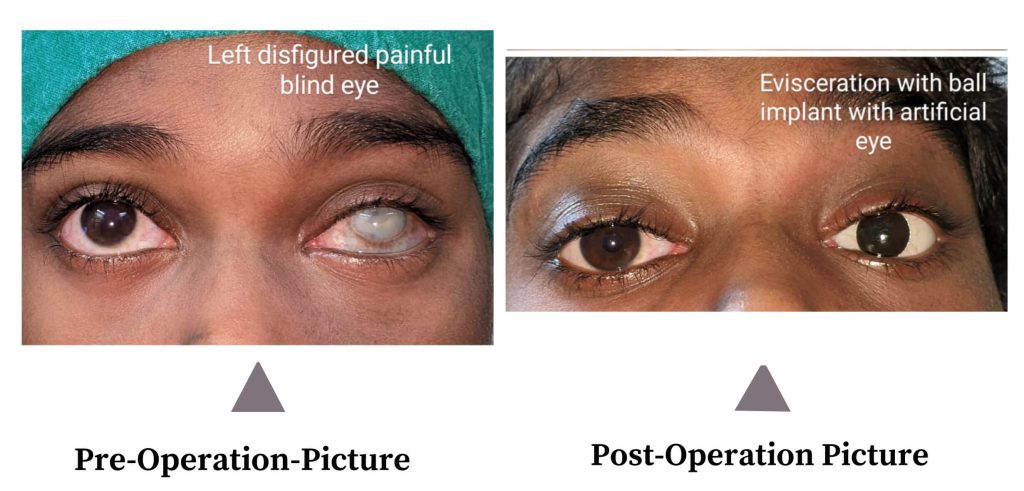 Left Disfigured Painful Blind Eye -Occuloplasty Case (Dr. Vasvi Joshi)