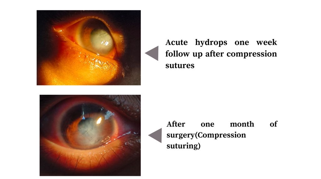 Swelling, Opacification and Forward Protrusion of Cornea (RE) – Cornea (Dr. Chetan Rathod)