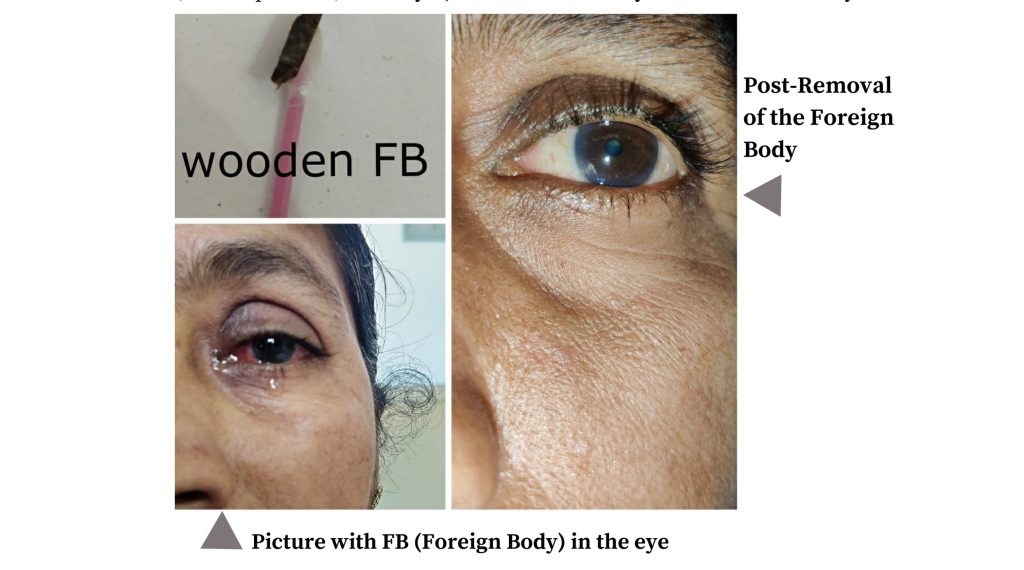 Pain, Redness and Lid Edema in the Right Eye with Wooden injury- Cataract (Dr. Ankita Patel)