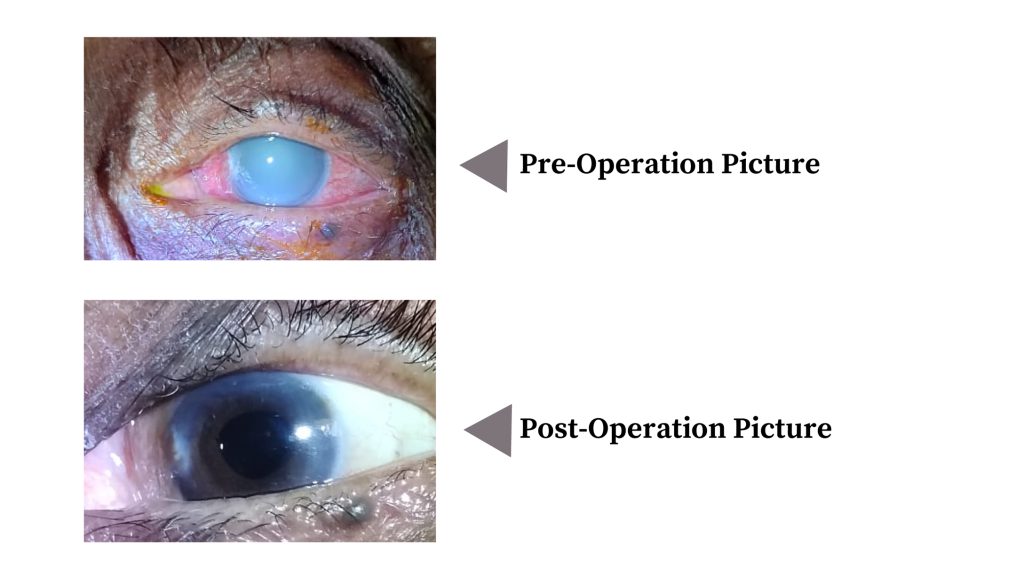 Pain, Redness & Diminishing of vision in left eye (LE) – Cataract (Dr. Archana Chaudhari)