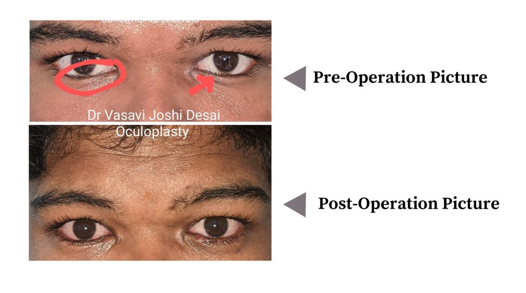 Both eyes Lower Lid Epiblepharon – Occuloplasty(Dr. Vasavi Joshi)