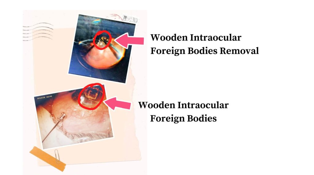 Wooden Intraocular Foreign Bodies in the righteye – Vitreo Retina (Dr. Vaibhavee Noticewala)