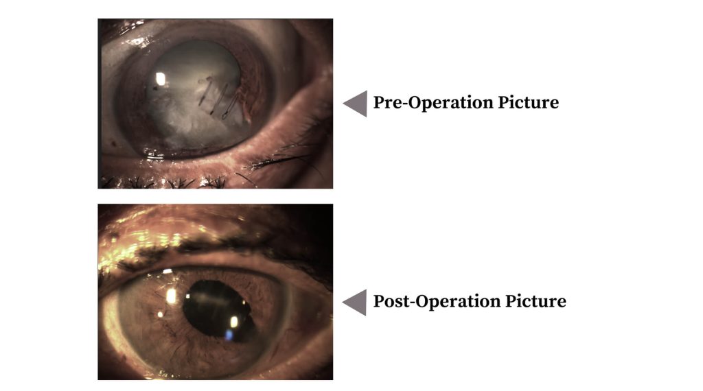 Wooden Stick Injury to the right eye – Cataract (Dr. Ankita Patel)