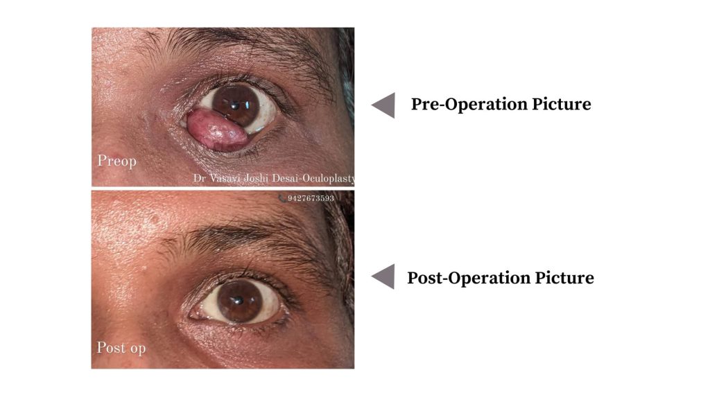 Left Eye Large Conjunctival Cyst- Occuloplasty Case (Dr. Vasvi Joshi)