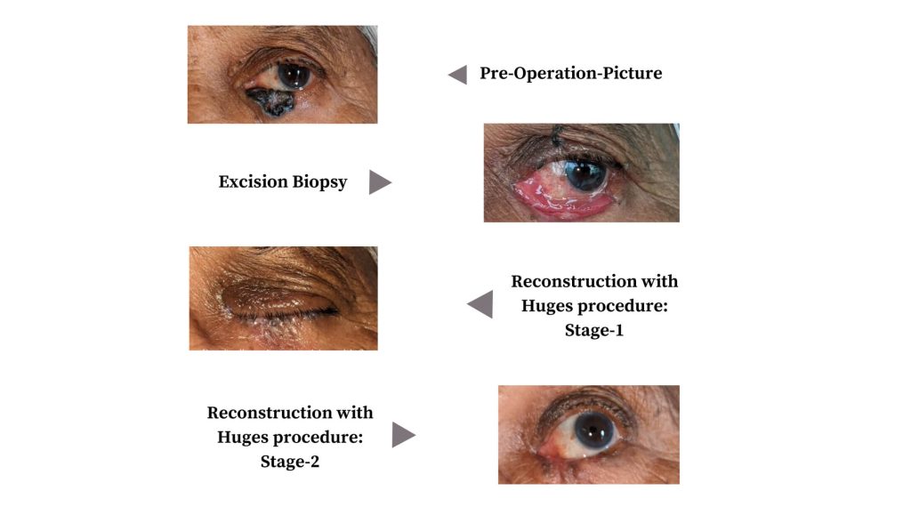 Left Eye Basal Cell Carcinoma (BCC) – Occuloplasty Case (Dr. Vasvi Joshi)