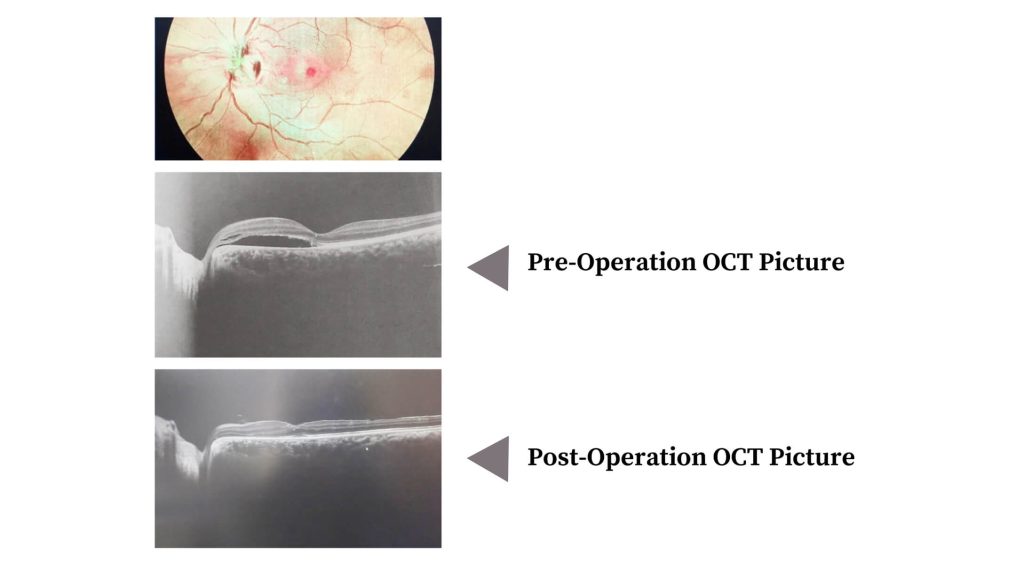 Optic Disc Pit with Persistent SRF at Macula in LeftEye- Vitreo Retina (Dr. Vaibhavee Noticewala)