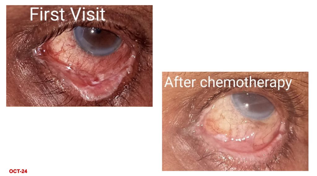 A Case of Eyelid Cancer Cure by Dr. Shalin Shah