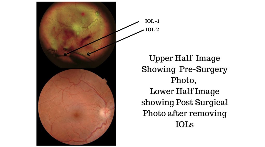 Double IOL (intraocular lens) Removal by Dr Vineet Shah